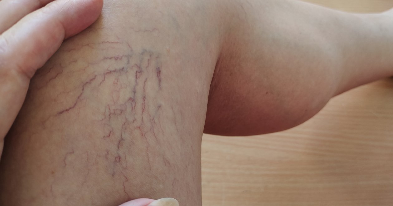 Mikor, milyen visszér elleni krémet érdemes használni?