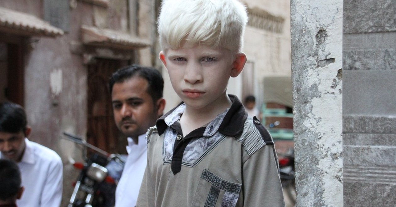 Albinizmus- Különleges gyermekek története 