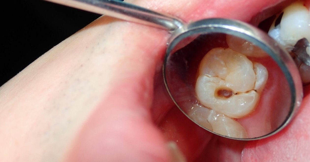 A cukortól valóban kihullhat a fogunk?